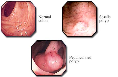 The picture contains three smaller pictures taken by a coloscope and representing a normal colon, a Sessile Polyp and a pedunculated polyp. The sessile polyp has just a small swallow, but the pedunculated polyp is big, covering almost the whole bowel passage.