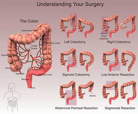 Complex representation meant to understand which part of the bowel is being recessed. It presents a picture of the colon on the left and six smaller pictures of the colon on the right. Is being presented a left and right colectomy, where is highlighted the left and right part of the colon; then a sigmoid and low anterior resection, where is highlighted the lower part of the rectum and the last two are abdominal perineal and segmental resections. The first one shows the very low part of the rectum where the segmental resection highlights the middle top part of the colon.