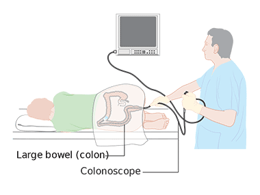 Graphic representation of a surgeon performing a colonoscopy. The patient is laid down on the bed, while the surgeon is controlling the colonoscope and observing the monitor located above him.