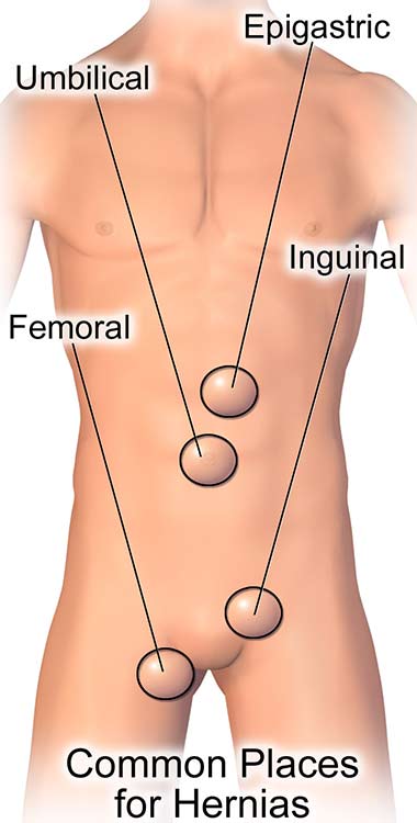 Representation of a human body showing common places for hernias. The lowest is femoral presented on the leg, followed by inguinal, just above the leg, umbilical where the stomach is and epigastric on top of the stomach.