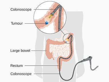 Representation of a colonscope inserted through the rectum, trying to localize a tumour. The pictures also contain a magnified portion of the large bowel, where the tumour is being highlighted in blue.