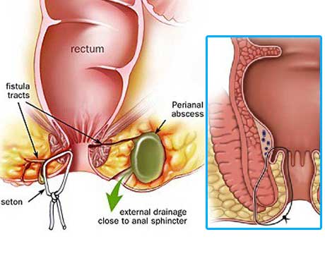 Coloured Representation of a fistulotomy. On the right of the picture is being magnified the fistula area and a seton inserted though the muscle.