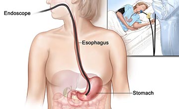 This is a representation of a gastroscopy.The patient lies on his/her left-hand side with a small plastic mouth guard placed between the teeth. The endoscopist is lowering the endoscope into the mouth, then down the back of the throat into the oesophagus.
