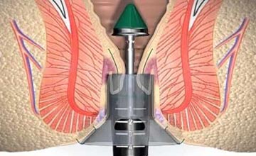 Graphical representation of a haemorrhoid procedure. Is being shown a tool inserted into the anus, clutching a haemorrhoid, ready to cut it.