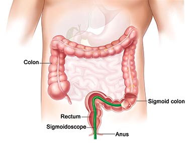 Graphic representation of the human body while a sigmoidoscopy is performed. It is highlited the colon and the green coloured sigmoidoscope inserted through the anus. 