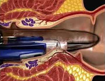 The THD and rectal mucopexy procedure. The tool is being shown inserted into the anus., ready to perform a transanal dearterialization 
