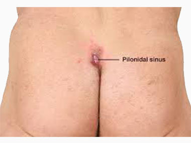 Picture of an ass showing a pilonidal sinus. It is  swollen lump in the sacral region, about 4-5 cm above the back passage. 