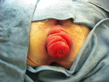 Image of a patient rectum before a surgery. The full-thiknes rectal prolapse is being expose.